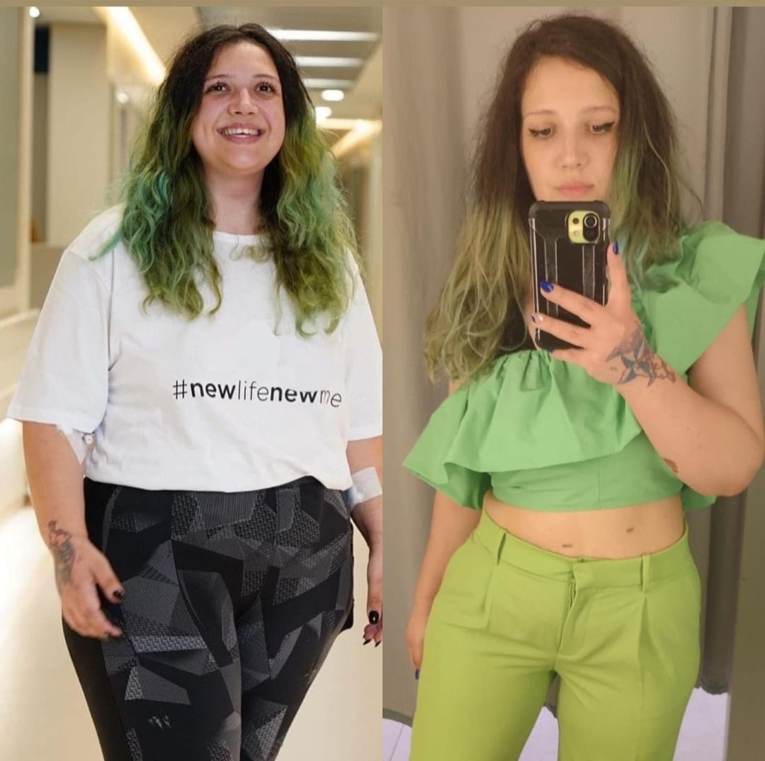 מיני מעקף בטורקיה מחיר