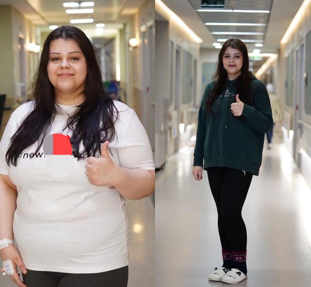 מיני מעקף בטורקיה מחיר