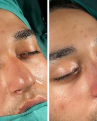 ניתוח אף בגאורגיה