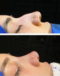 ניתוח אף בגאורגיה